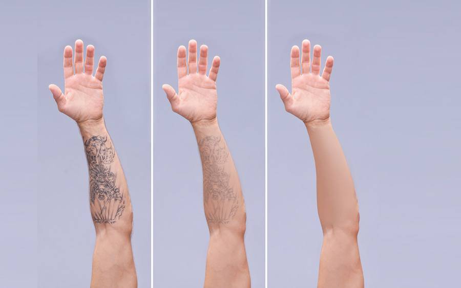 Tattoo removal is more effective today thanks to laser treatment.