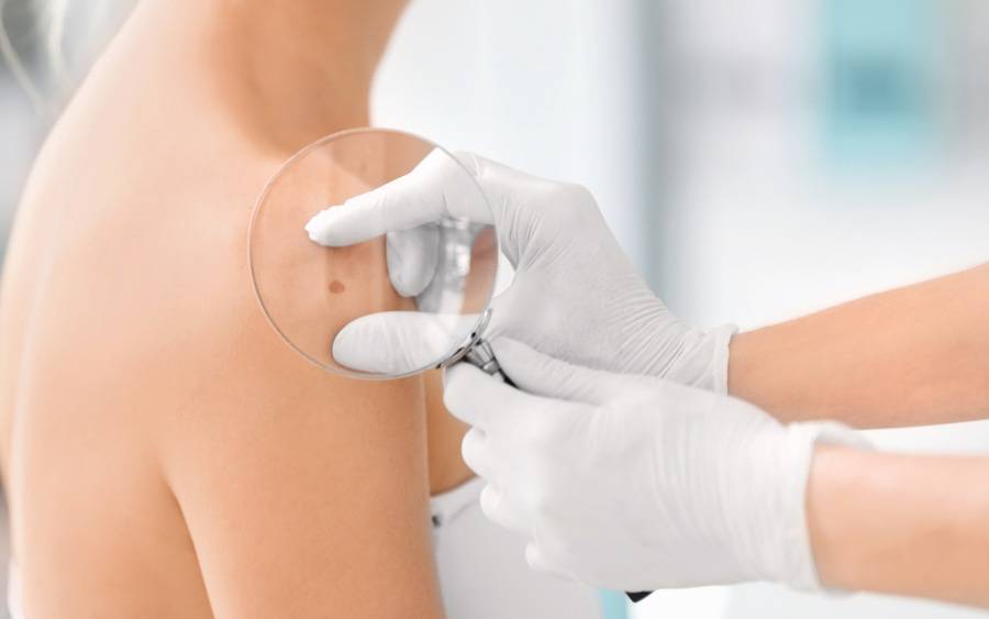 A patient is checked for skin cancer, including melanoma.