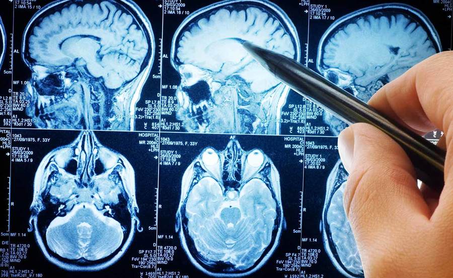 A person points to a brain scan, representing the quality data for the stroke program at Scripps.